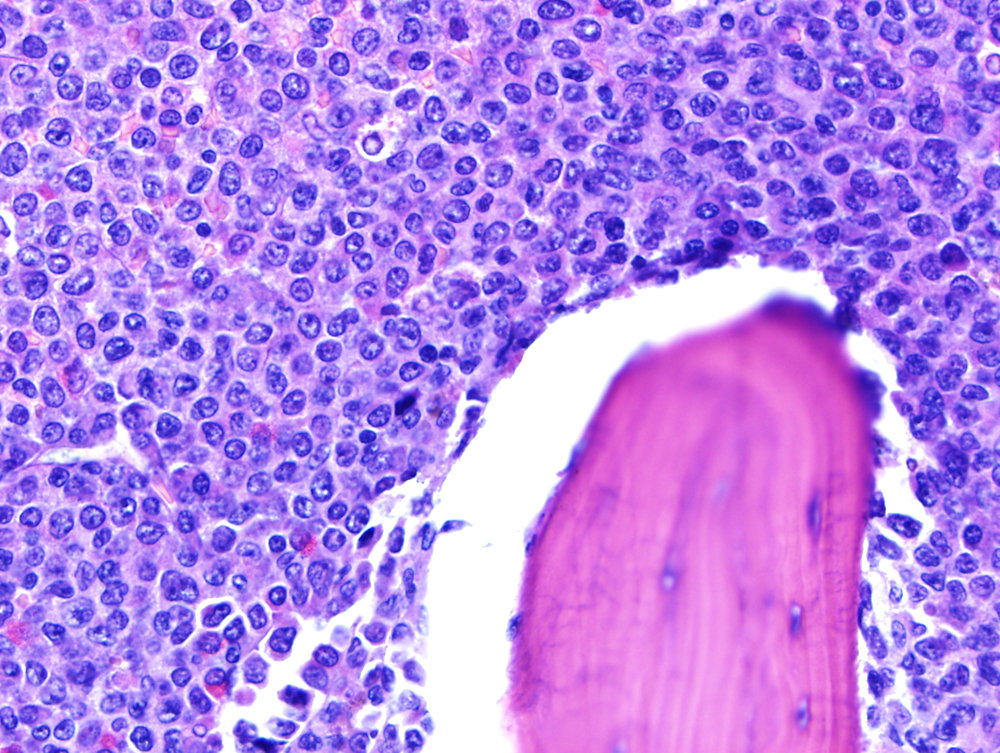 2010, hypercellular bone marrow biopsy